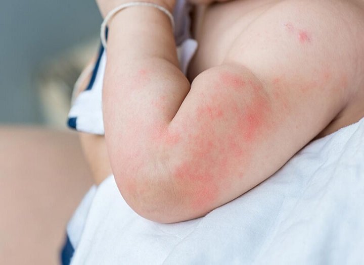 Cháo đậu xanh có gây dị ứng cho bé không và cách nhận biết sớm dấu hiệu